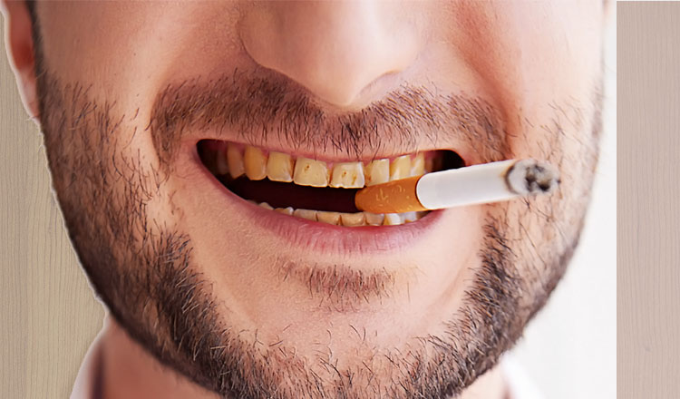 Răng ố vàng – Tác hại của thuốc lá bạn nên khắc phục sớm